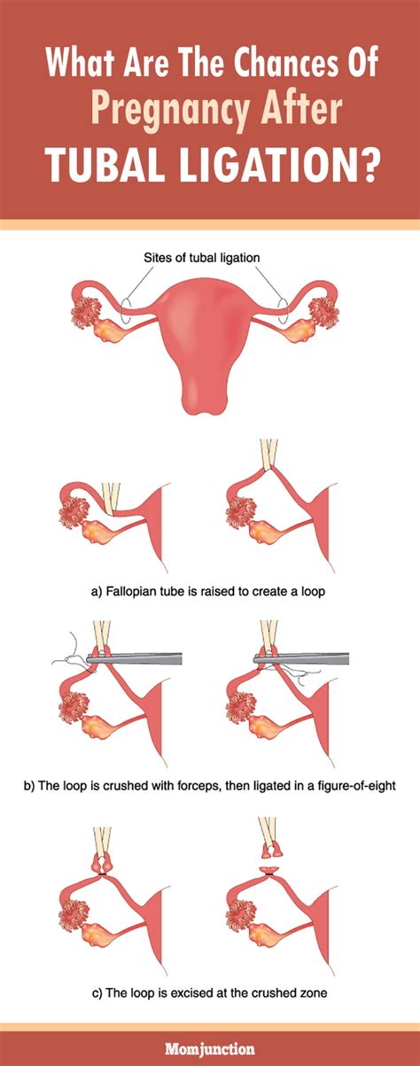 Shocking Answer: After Tubal Ligation Can Women Still Get Pregnant?